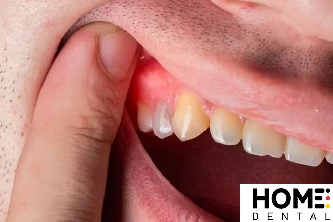 Sưng Bọng Răng Phải Làm Gì? Cách Xử Lý Hiệu Quả Tại Nhà