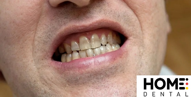 Răng Bị Đổi Màu Xám Đục: Nguyên Nhân và Cách Khắc Phục