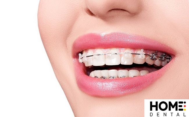 Cần chú ý gì khi nhổ răng 4r4 để niềng?