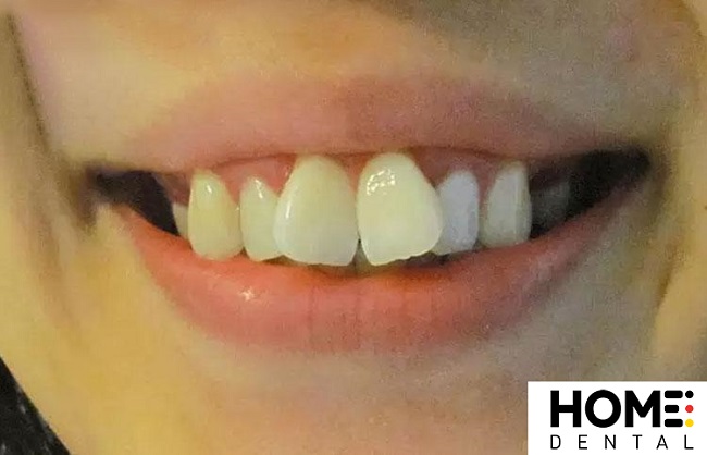 Tướng Răng Cánh Bướm: Ý Nghĩa và Tác Động Tốt Xấu