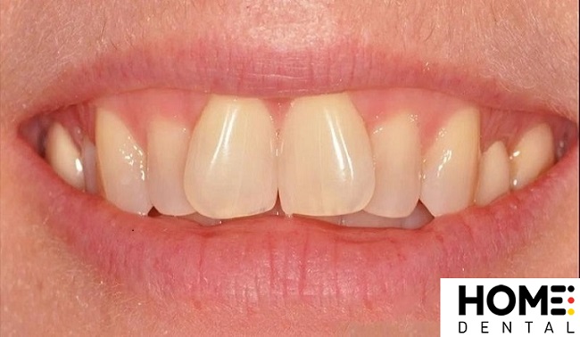 Niềng răng cửa chữ V giá bao nhiêu?