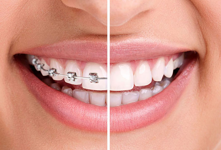 Bị vẩu nên bọc răng sứ hay niềng răng