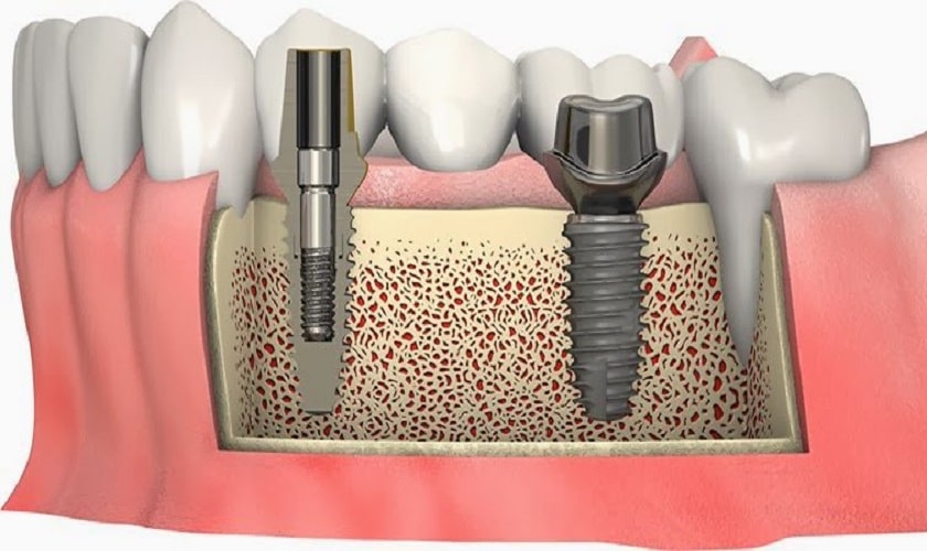 Mất Tích Hợp Implant Là Gì? Nguyên Nhân và Cách Khắc Phục