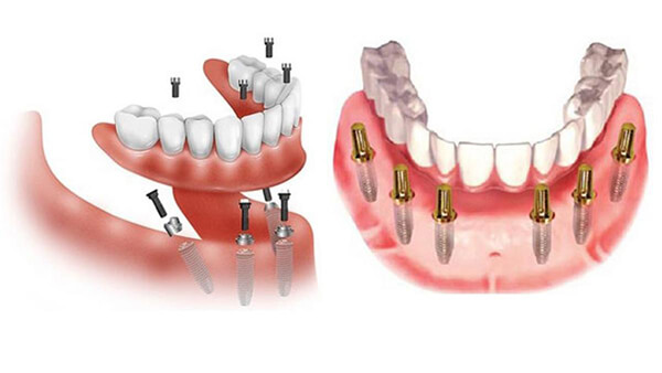 Trường Hợp Nào Nên Trồng Răng Implant All-On-6?