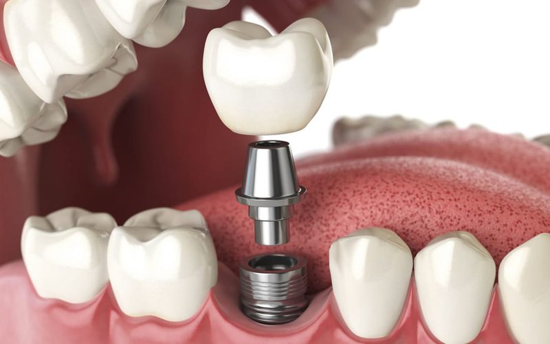 Những điều cần biết về gây tê trong cấy ghép răng Implant