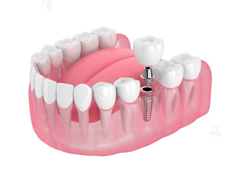 TRỒNG RĂNG IMPLANT SỬ DỤNG ĐƯỢC BAO LÂU?