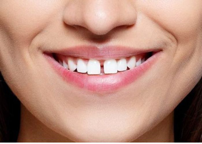 Niềng răng thưa có đau không  – 4 cách giúp giảm đau hiệu quả