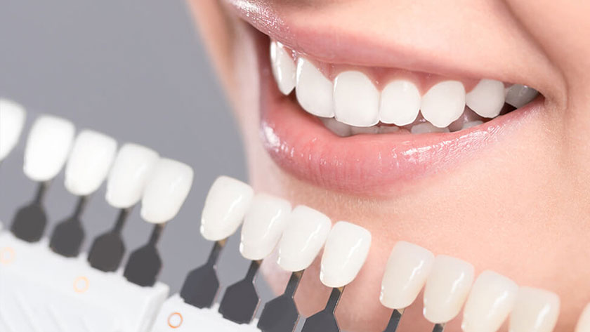 Dán sứ Veneer có mấy loại? Loại nào tốt nhất?